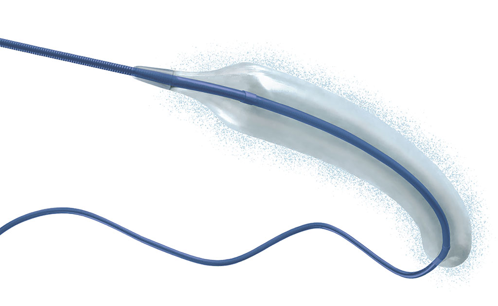 Illustration of the drug coated balloon